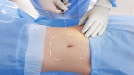 من جربت شفط دهون البطن