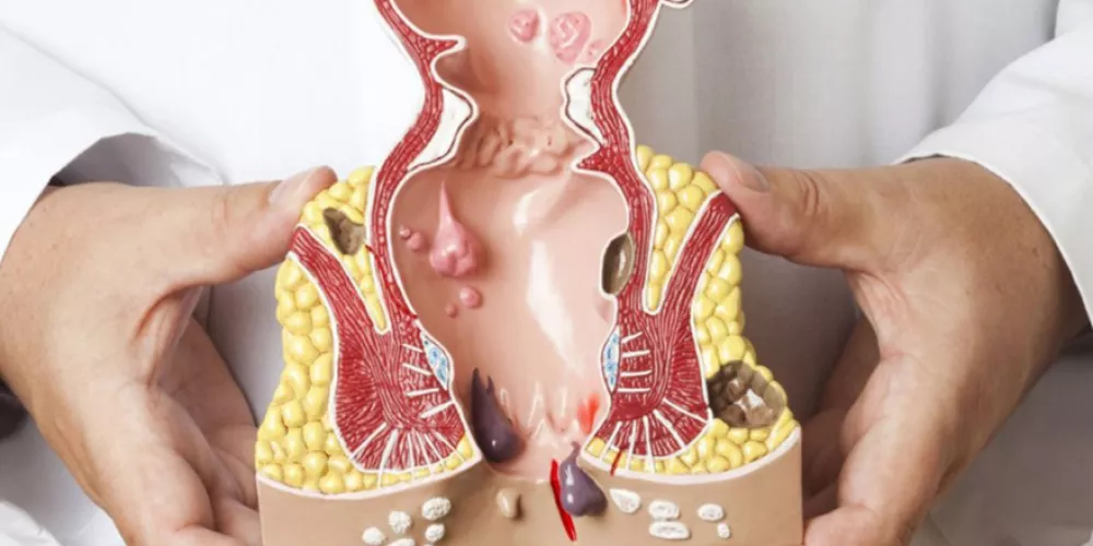 تجربتي مع عملية البواسير