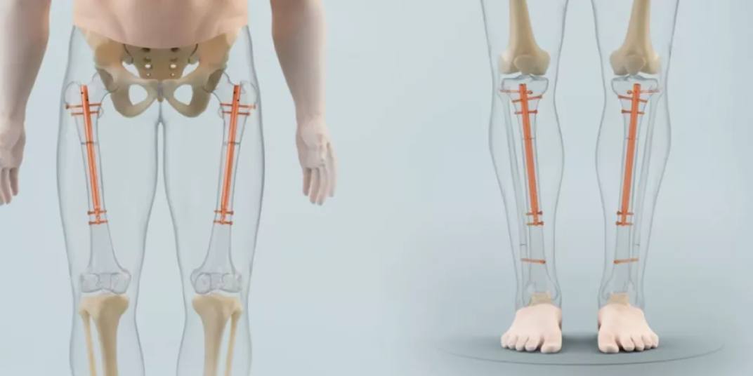 تجربتي مع عملية زيادة الطول