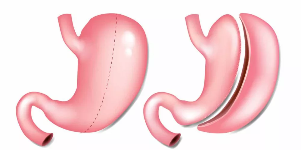 تجربتي مع عملية التكميم