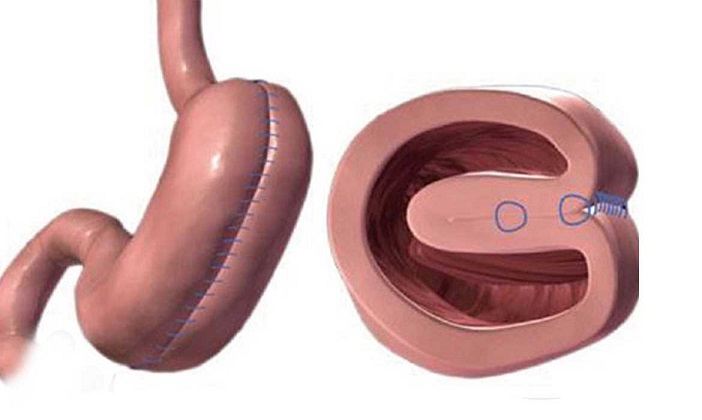تجربتي مع عملية طي المعدة
