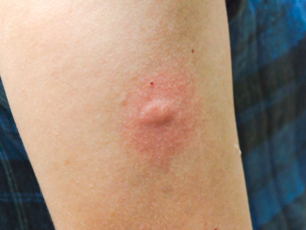 تفسير حلم لسعة حشرة غريبة للمتزوجة